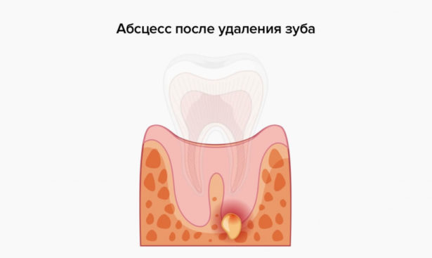 Почему болит место где удалили зуб