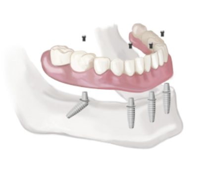 Имплантация зубов за один день: революционная технология в стоматологии